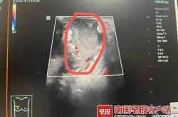 13岁男孩确诊乳腺炎非女性专属 男性亦需警惕