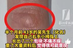 43岁男子手指异样怀疑感染HPV 竟是持机姿势不当所致